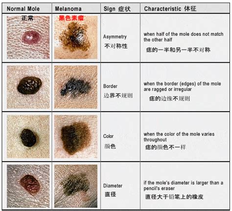 痣是凸的|为什么身上突然长出新痣？容易恶变吗？